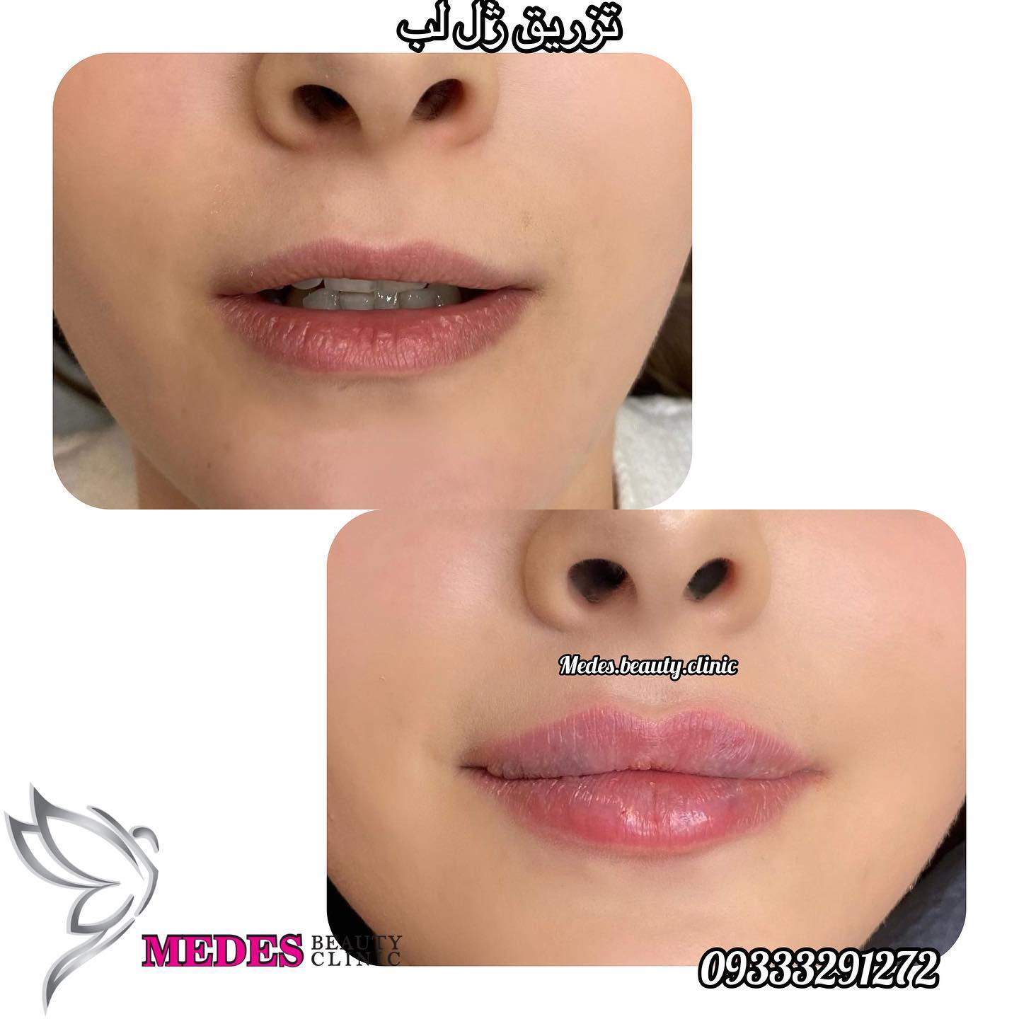 گالری تزریق ژل لب